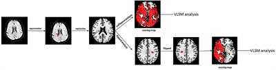 Association of Lesion Location and Fatigue Symptoms After Ischemic Stroke: A VLSM Study